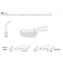 Punta ultrasonidos Woodpecker DTE PD5, rosca tipo S y comp. | Perio